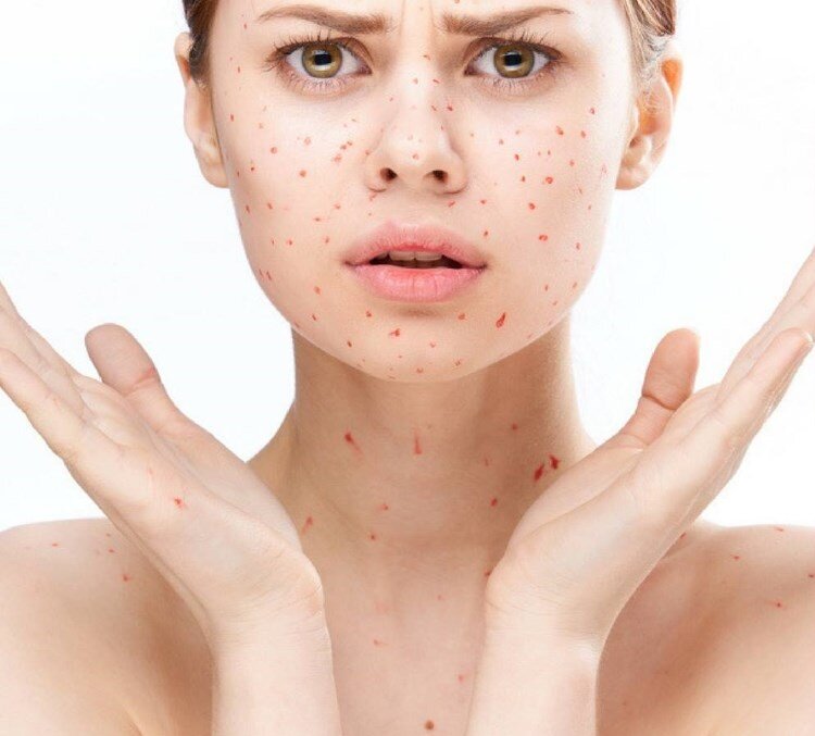 Гнойничковые заболевания кожи